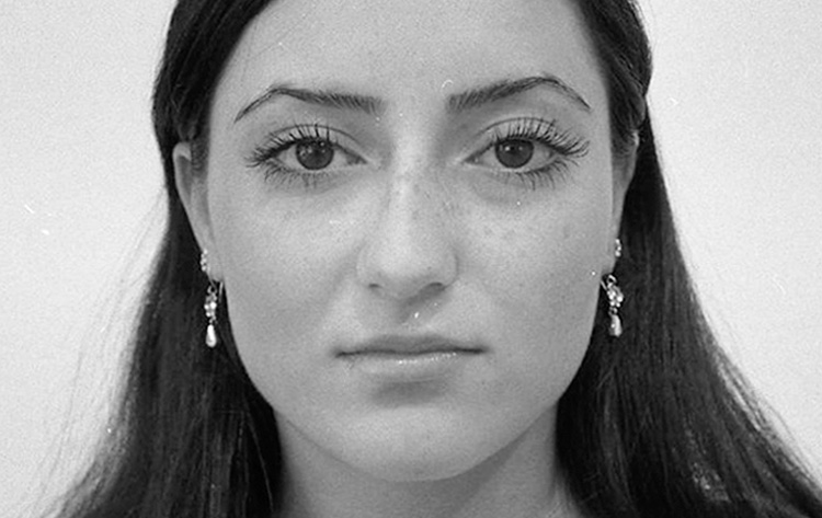 Einfache H&ouml;ckernase. Vor der Operation.