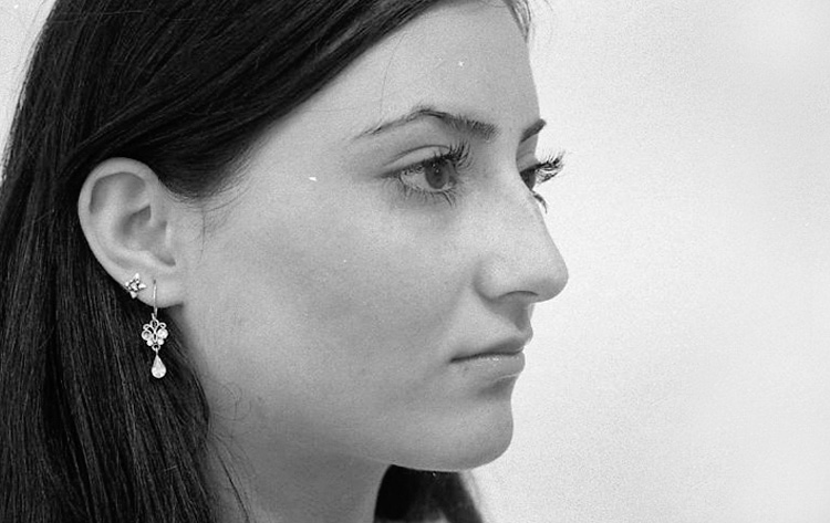 Einfache H&ouml;ckernase. Vor der Operation.