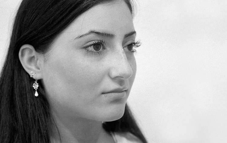 Einfache H&ouml;ckernase. Vor der Operation.