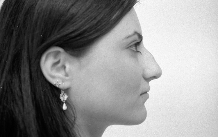 Einfache H&ouml;ckernase. Vor der Operation.