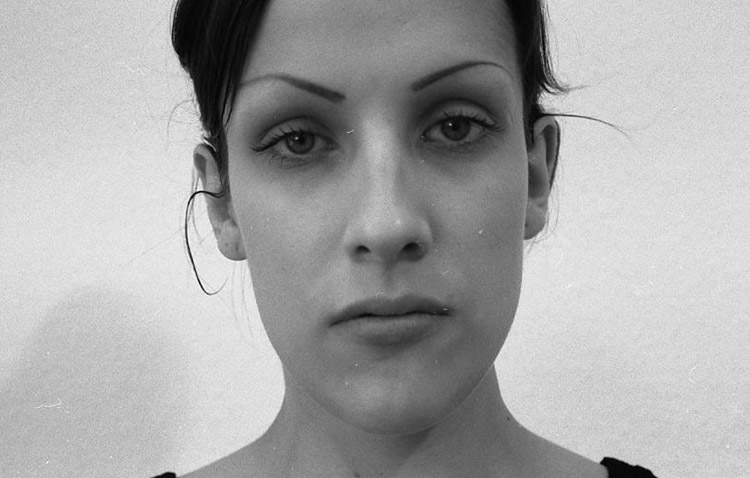 Einfache H&ouml;ckernase, vor der Operation