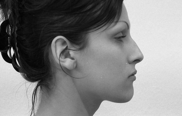 Einfache H&ouml;ckernase, vor der Operation