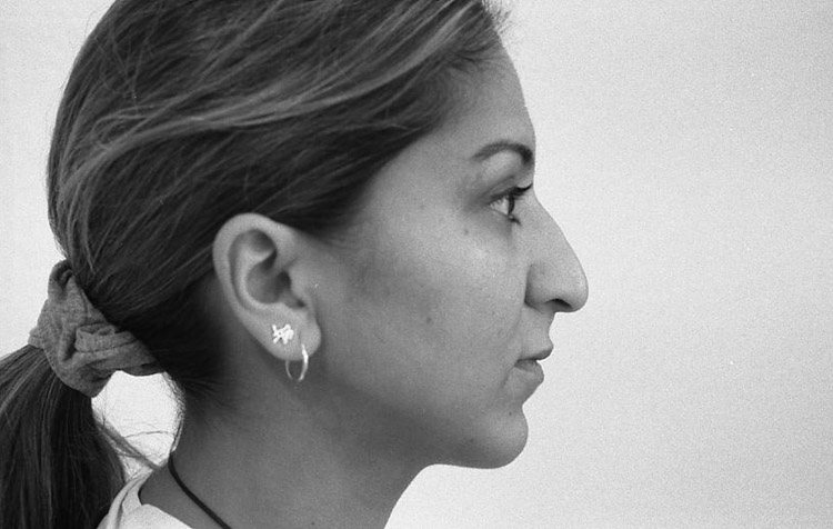 H&ouml;ckernase, gro&szlig;bogig mit h&auml;ngender Spitze, vor der Operation.