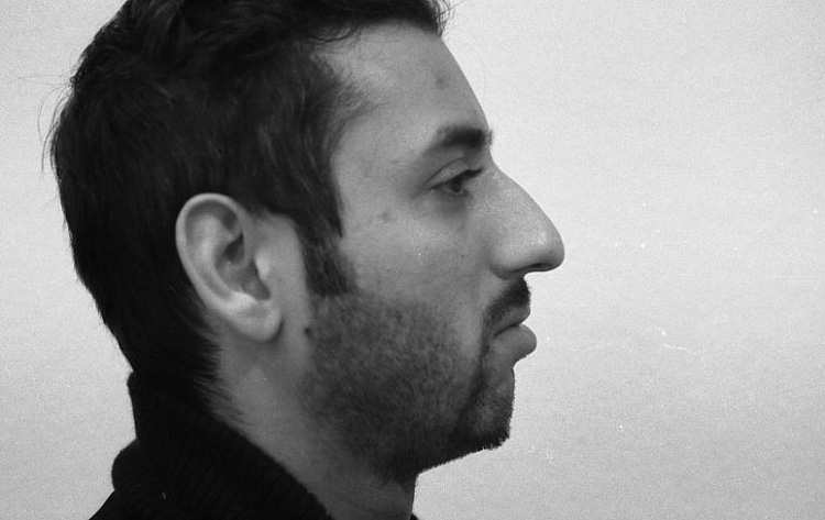 H&ouml;cker-Langnase, gro&szlig;bogig mit breiter Spitze. Vor der Operation.