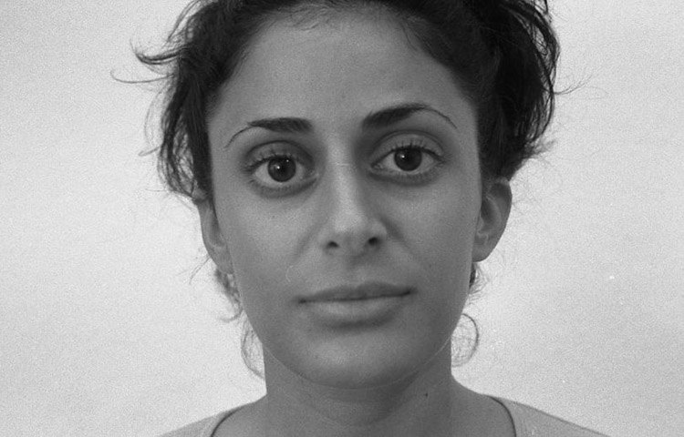 H&ouml;cker-Gro&szlig;nase, bei Gesichtsasymmetrie und schiefem Nasensteg. Vor der Operation.