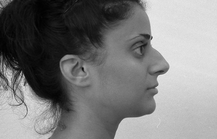 H&ouml;cker-Gro&szlig;nase, bei Gesichtsasymmetrie und schiefem Nasensteg. Vor der Operation.