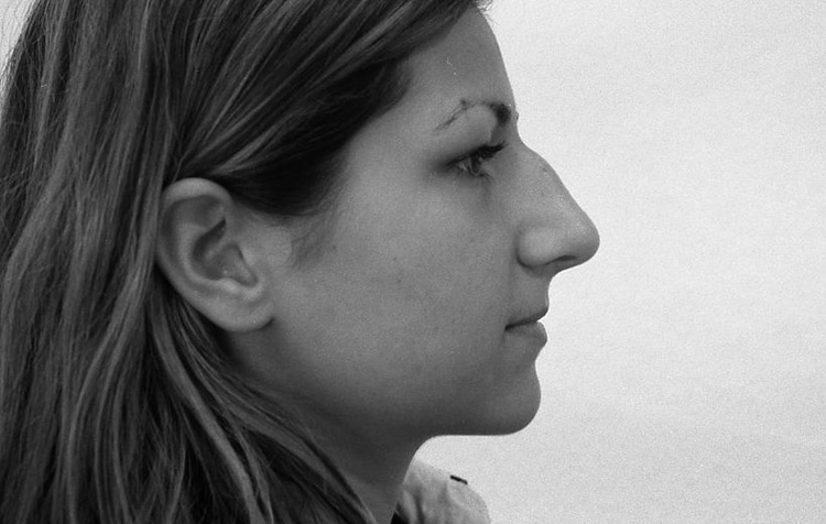 H&ouml;cker-Gro&szlig;nase, vor der Operation. 