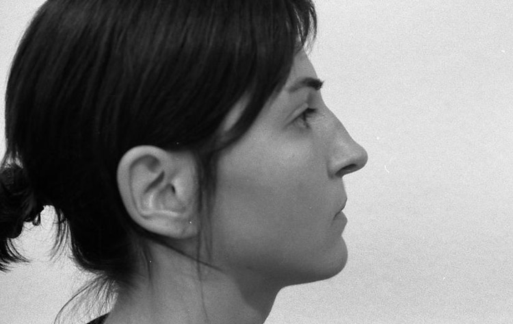 H&ouml;cker-Langnase mit kleinem Sattel und etwas zu langer Spitze. Vor der Operation.