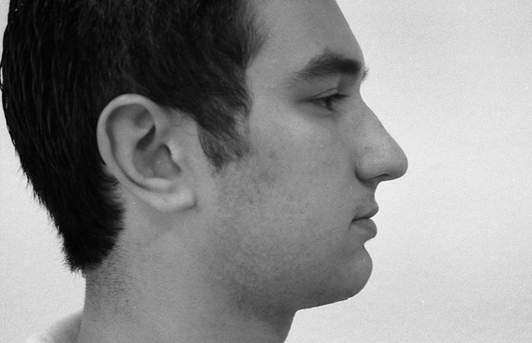 Unf&ouml;rmig breite Nase. Vor der Operation. 