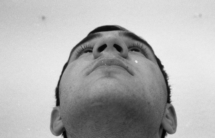 Unf&ouml;rmig breite Nase. Vor der Operation. 