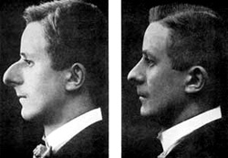 Ein Bild aus seinem Lehrbuch H�cker-Gro�-Nase vor u. nach OP